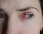 Congiuntivite Allergica: di cosa si tratta?